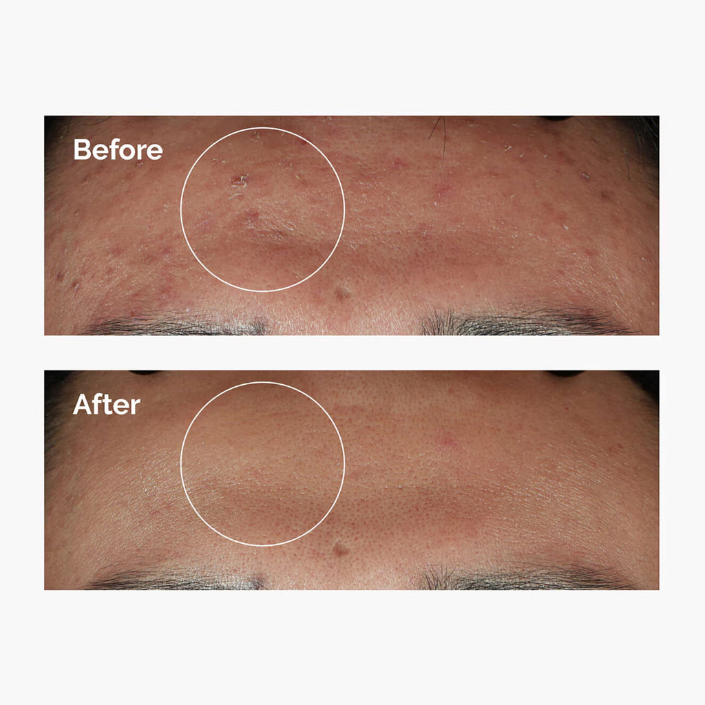 Ordinary Niacinamide 10% + Zinc 1%